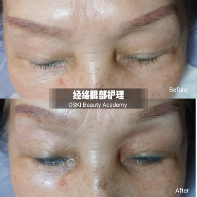 Traditional Meridian Scraping Eye Treatment/传统经络眼部治疗